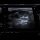 Metastatic infiltration of lymph nodes: US - Ultrasound